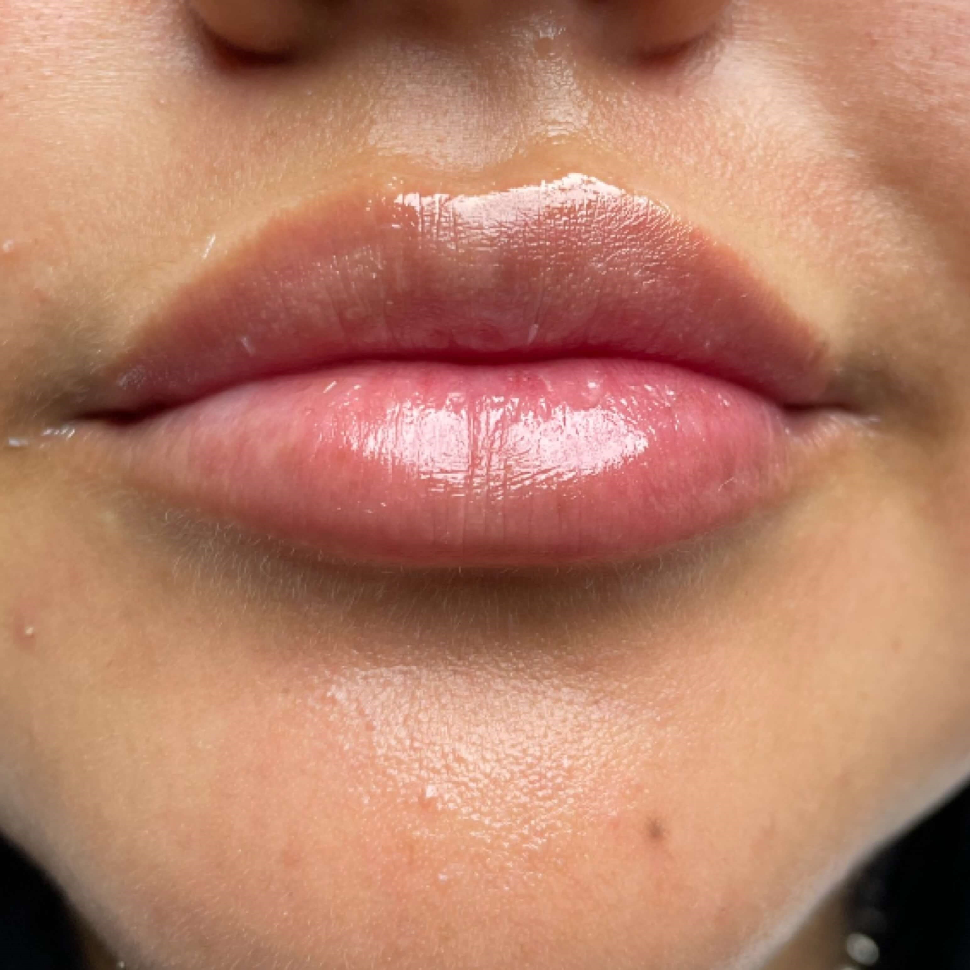 Lip Filler Before Lip Filler Before