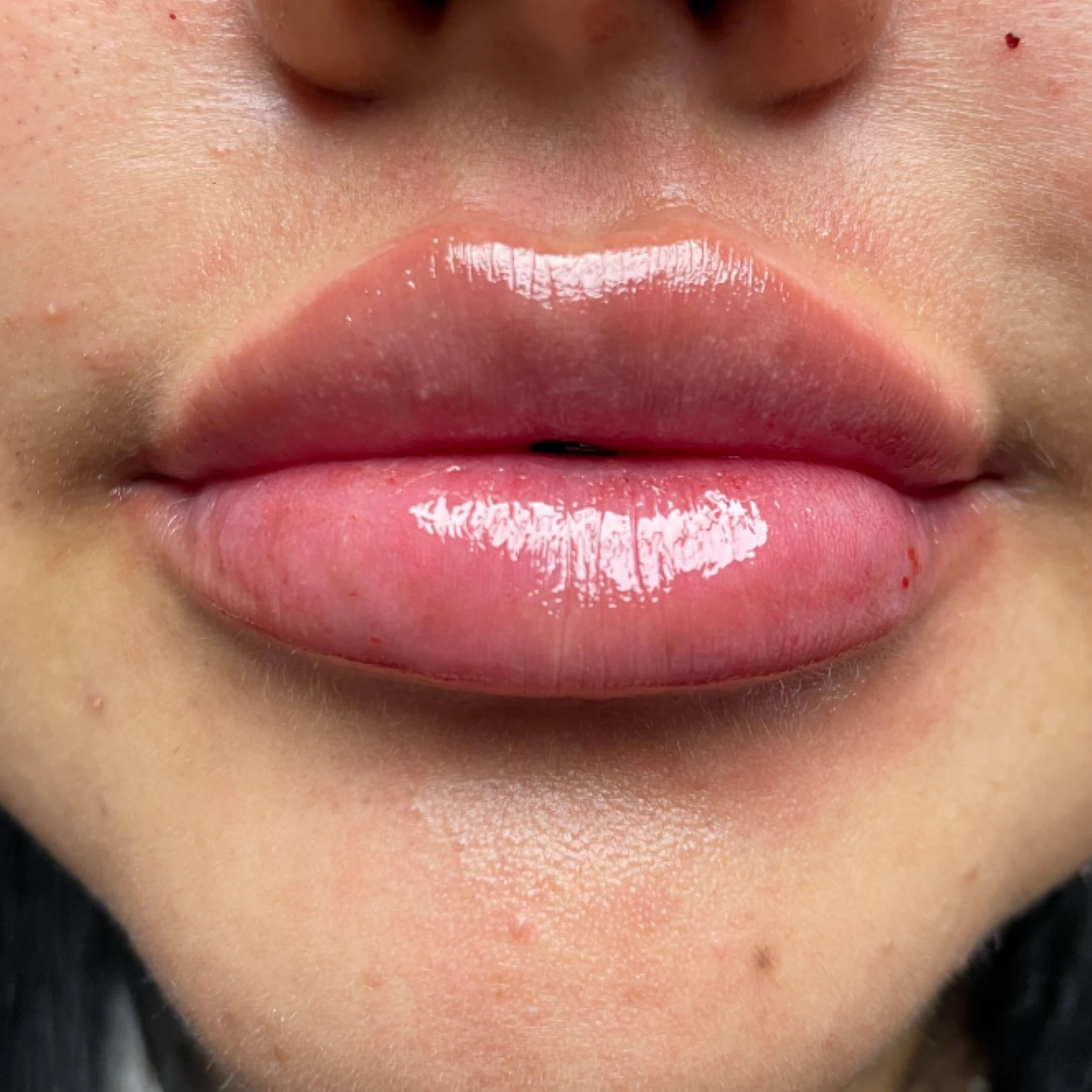 Lip Filler After Lip Filler After