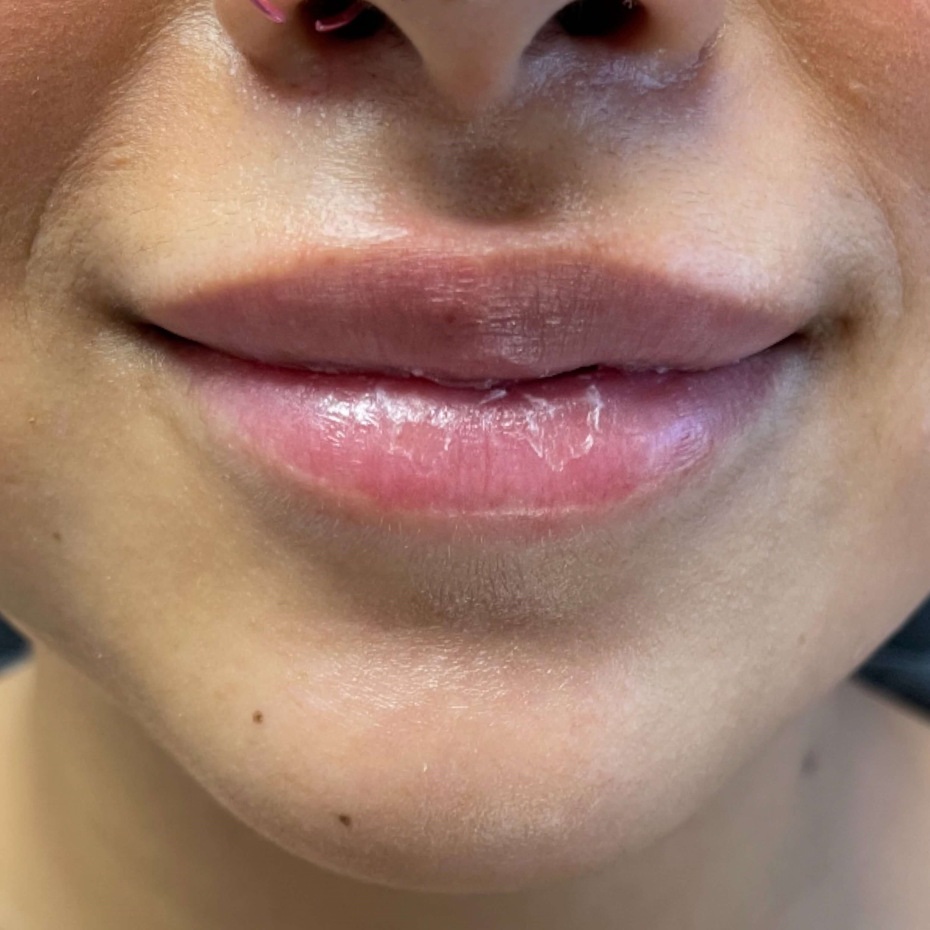 Lip Filler Before Lip Filler Before