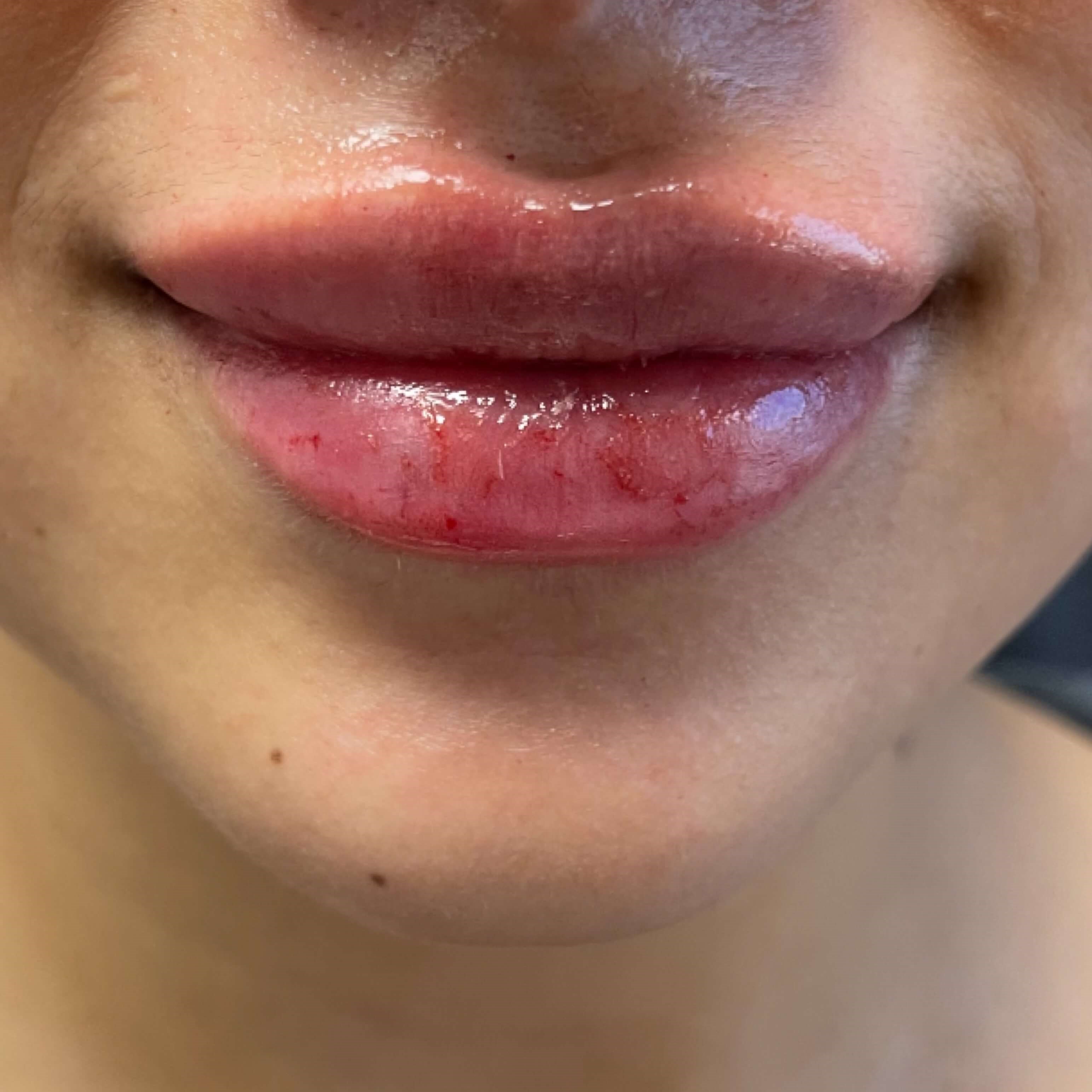 Lip Filler After Lip Filler After