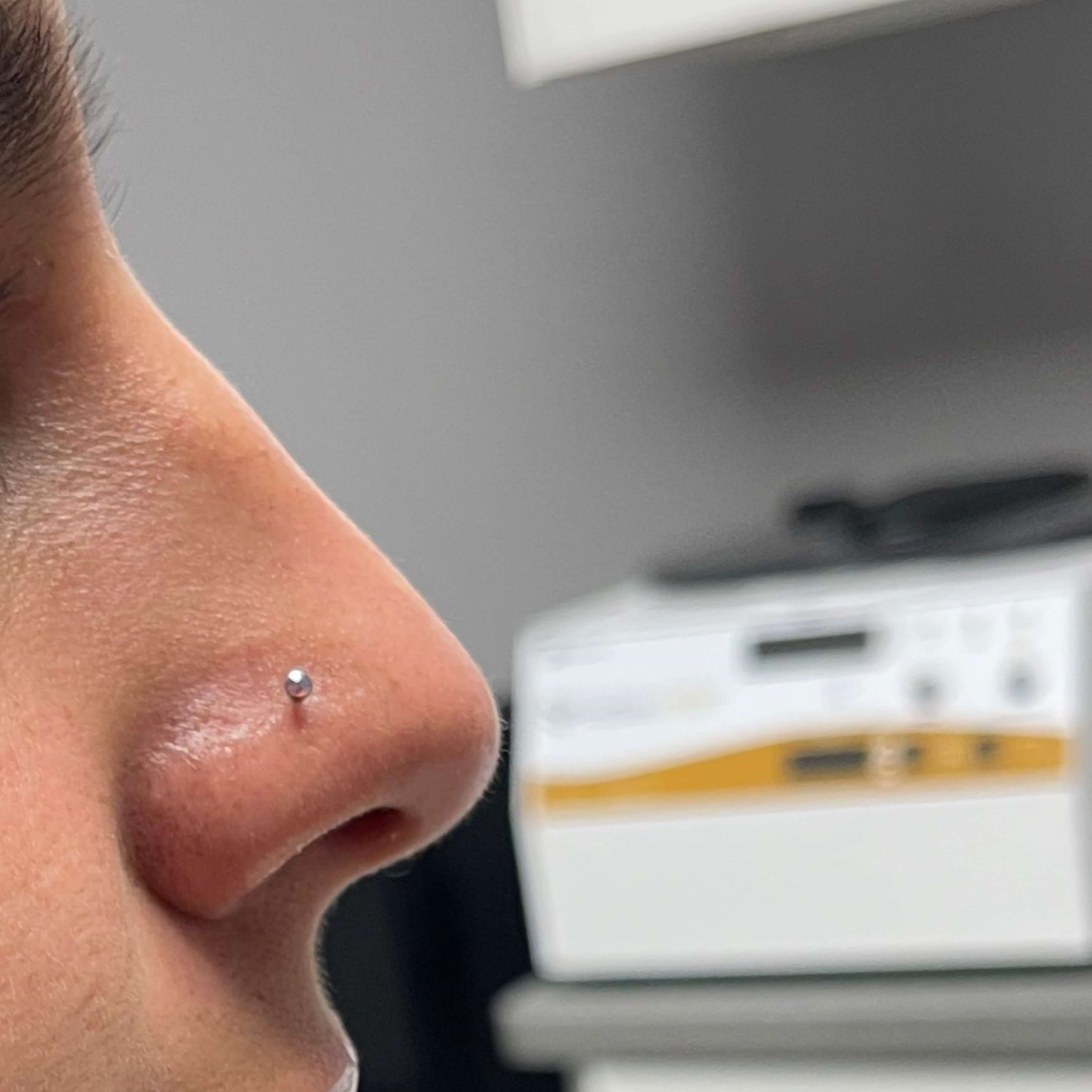 Non Surgical Rhinoplasty Before