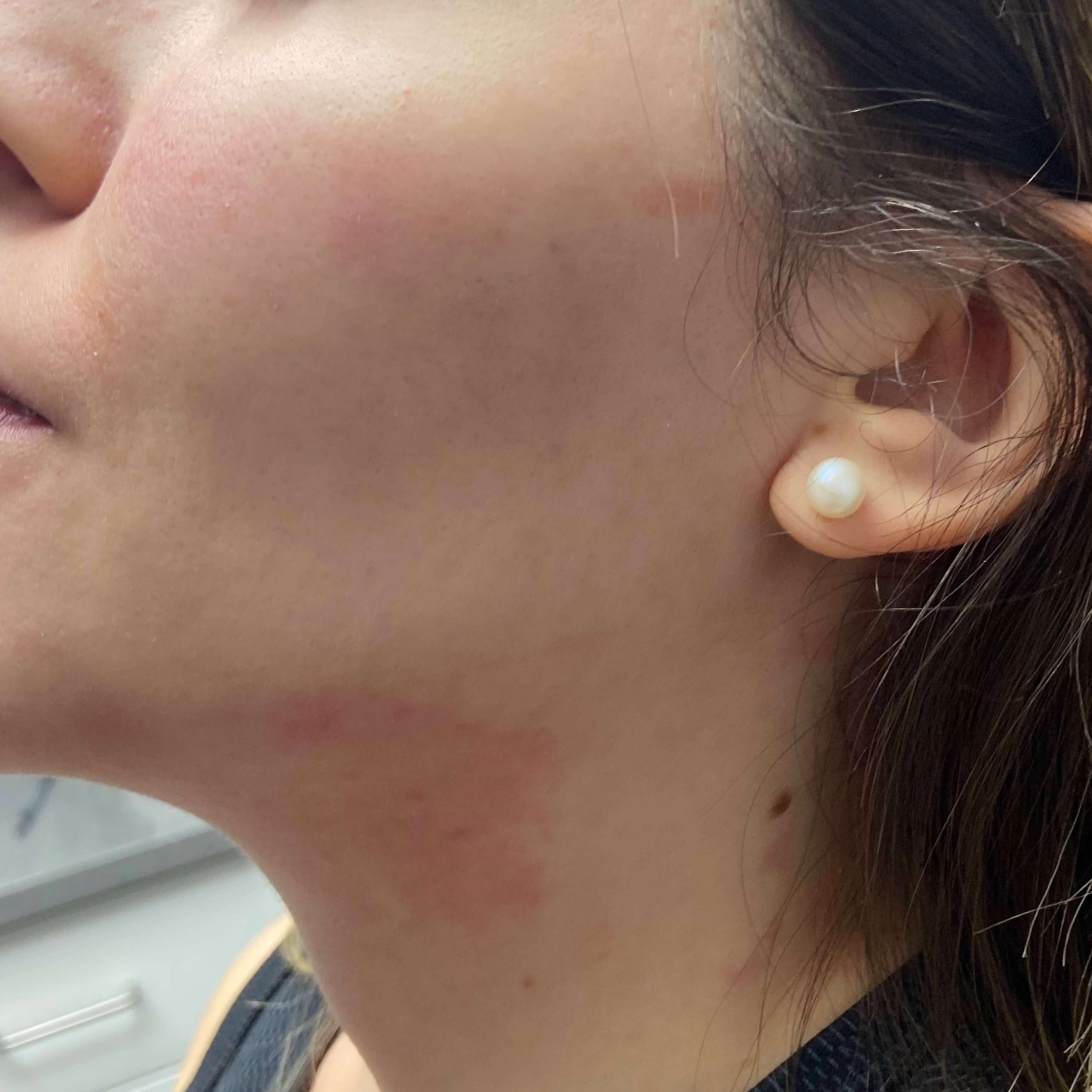 Jawline Filler Before