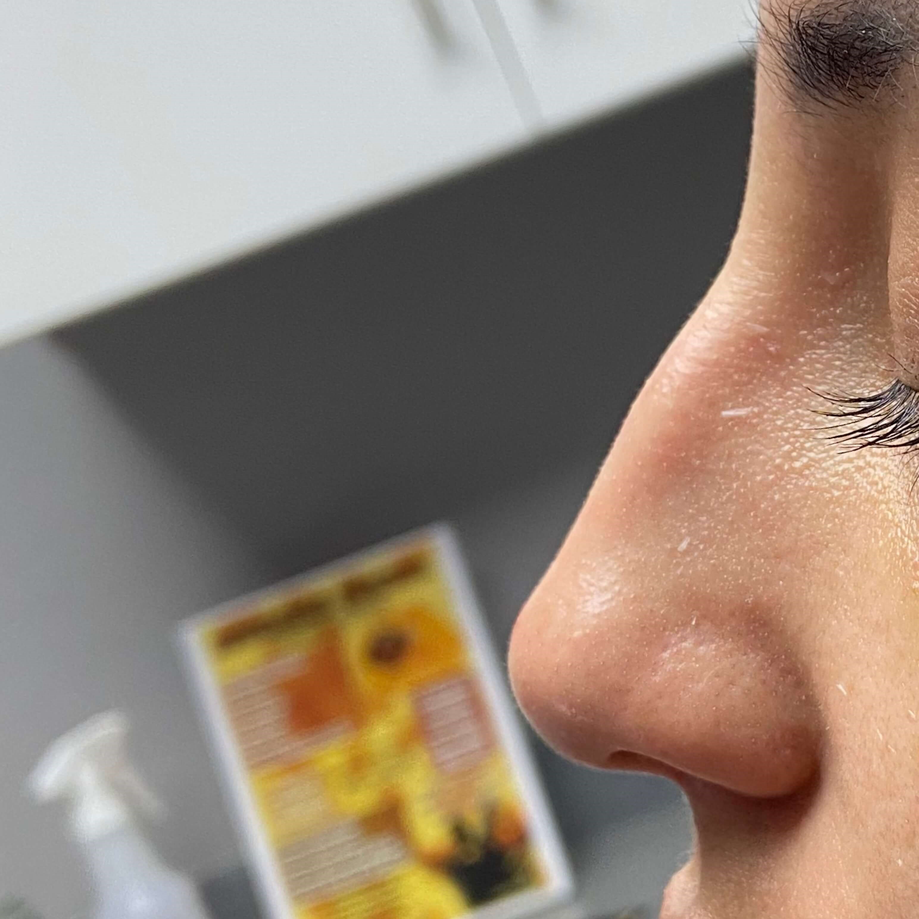 Non Surgical Rhinoplasty Before