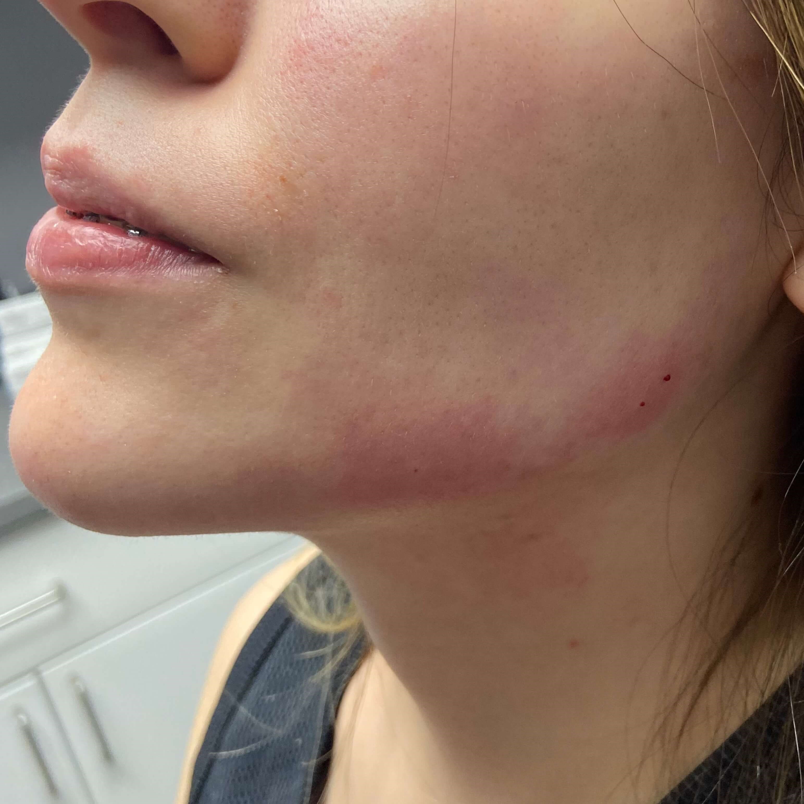 Jawline Filler After