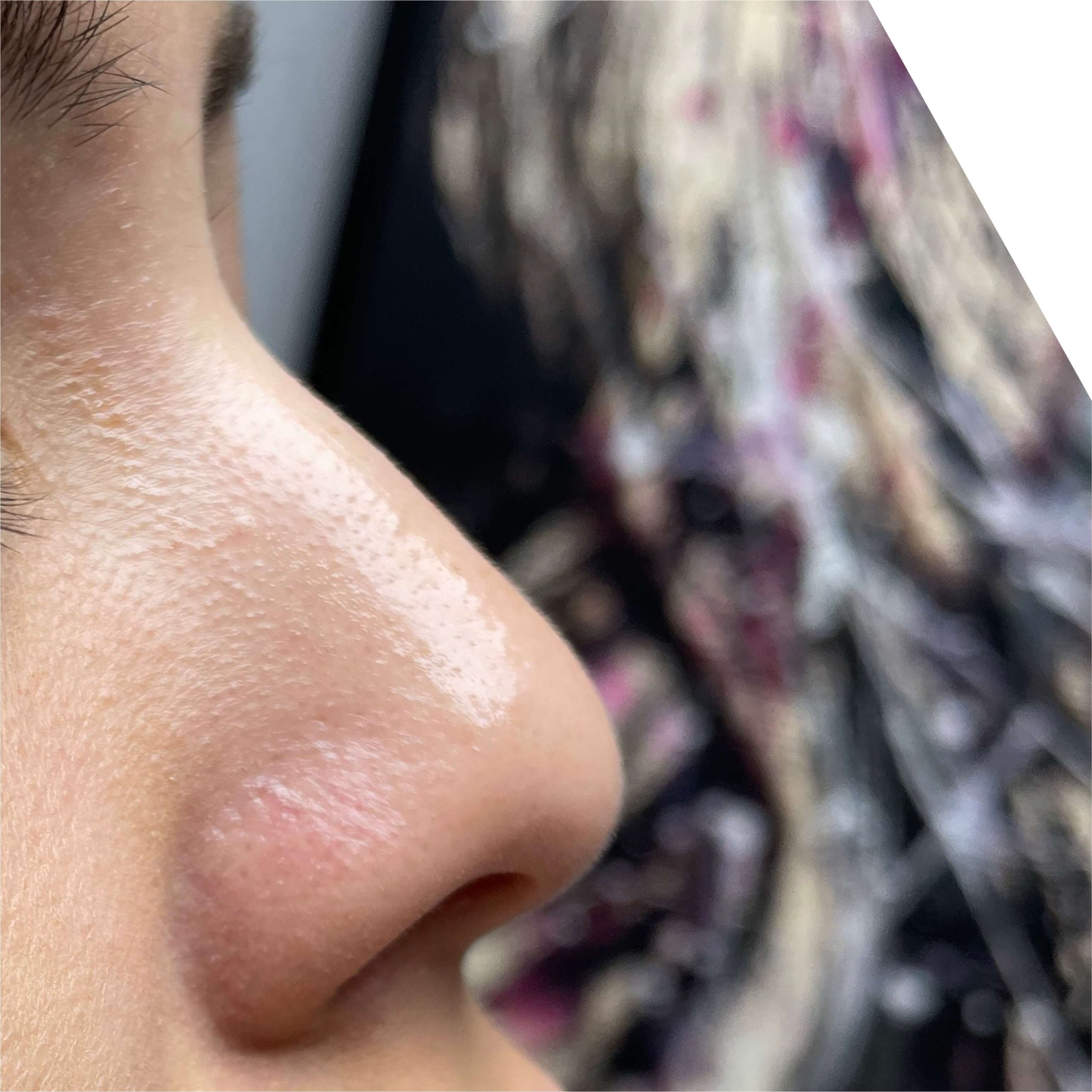 Non Surgical Rhinoplasty Before