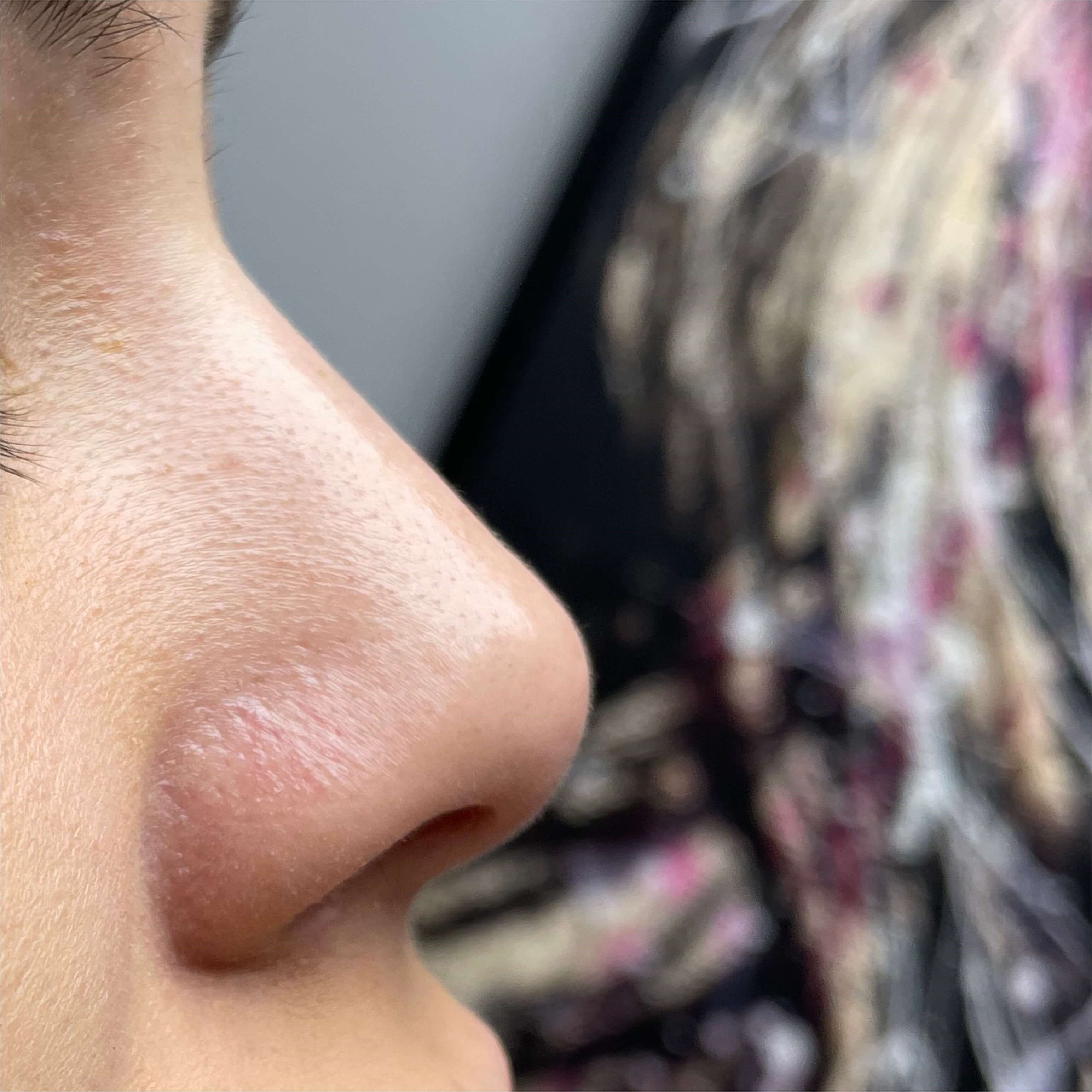 Non Surgical Rhinoplasty After