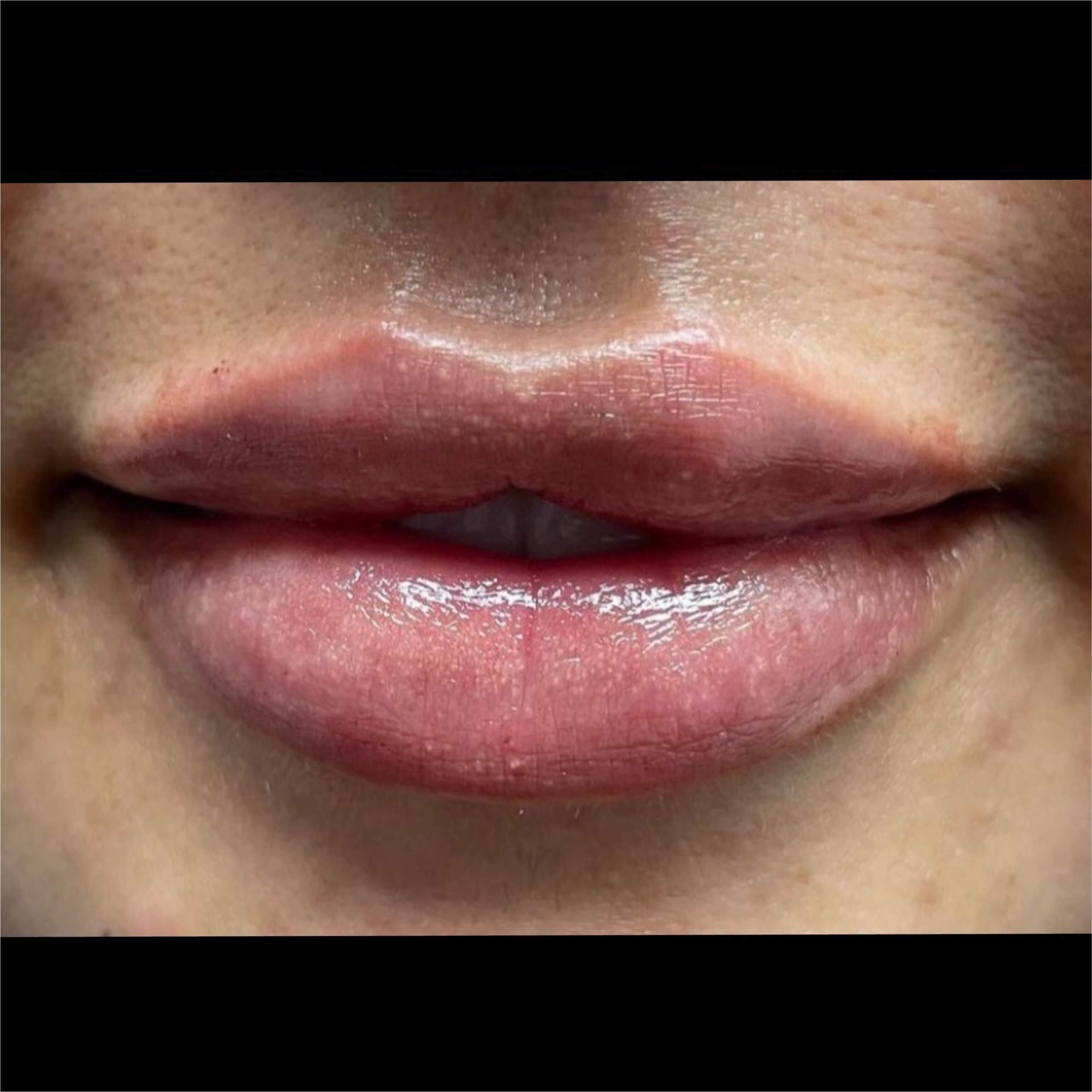 Lip Filler After