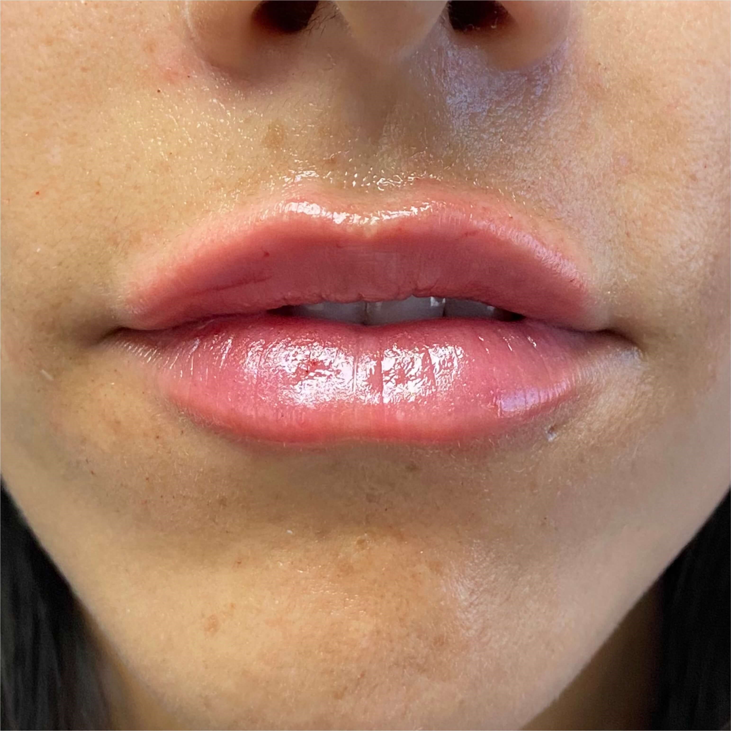 Lip Filler After