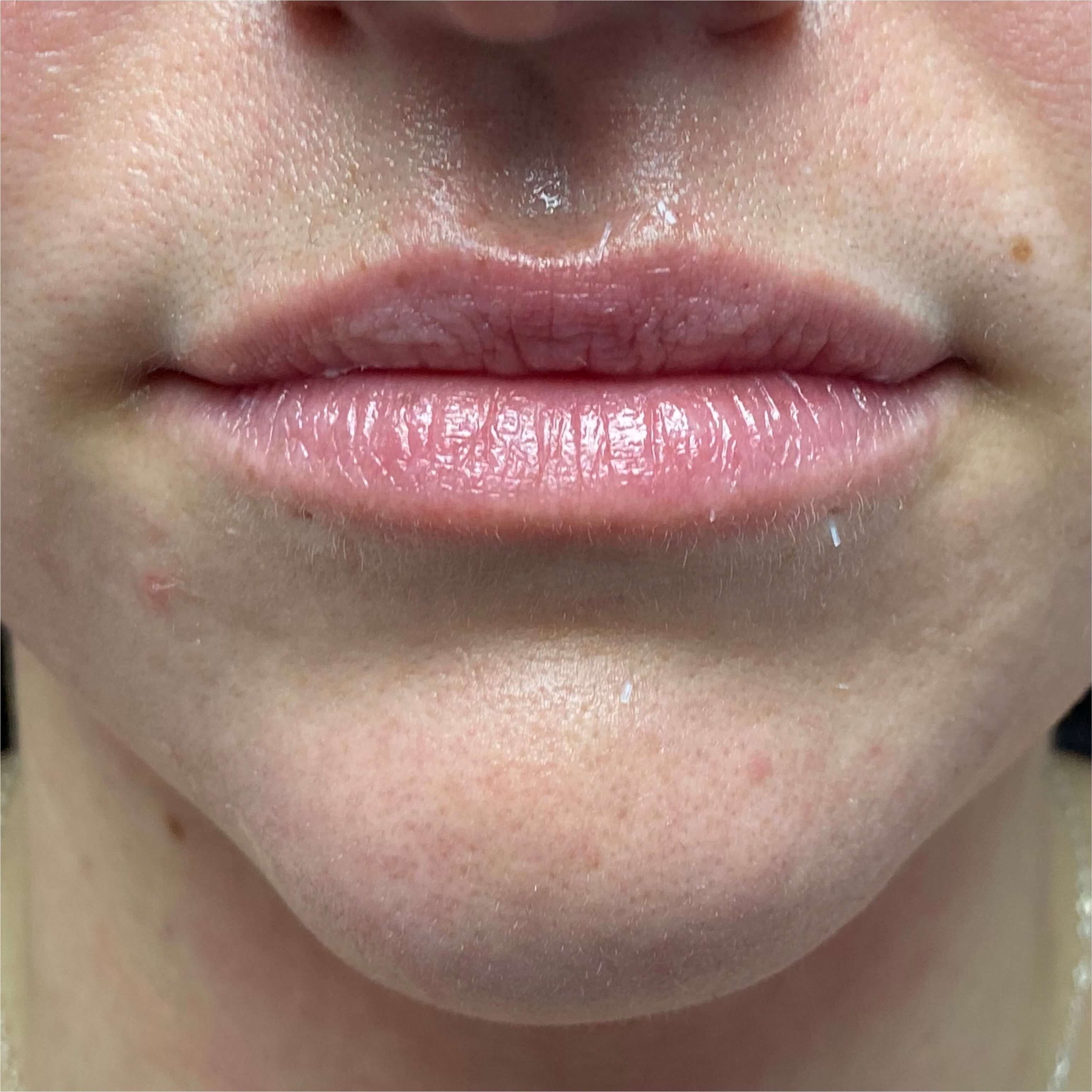 Lip Filler Before & After