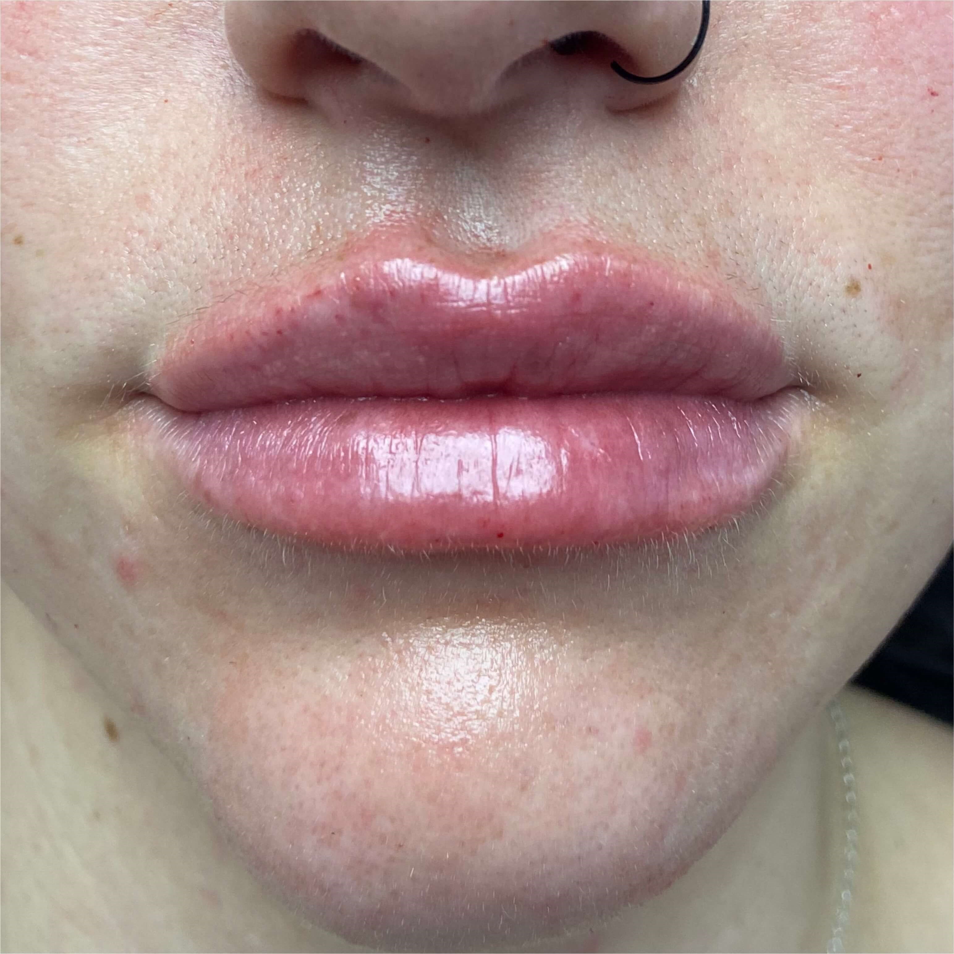 Lip Filler Before & After