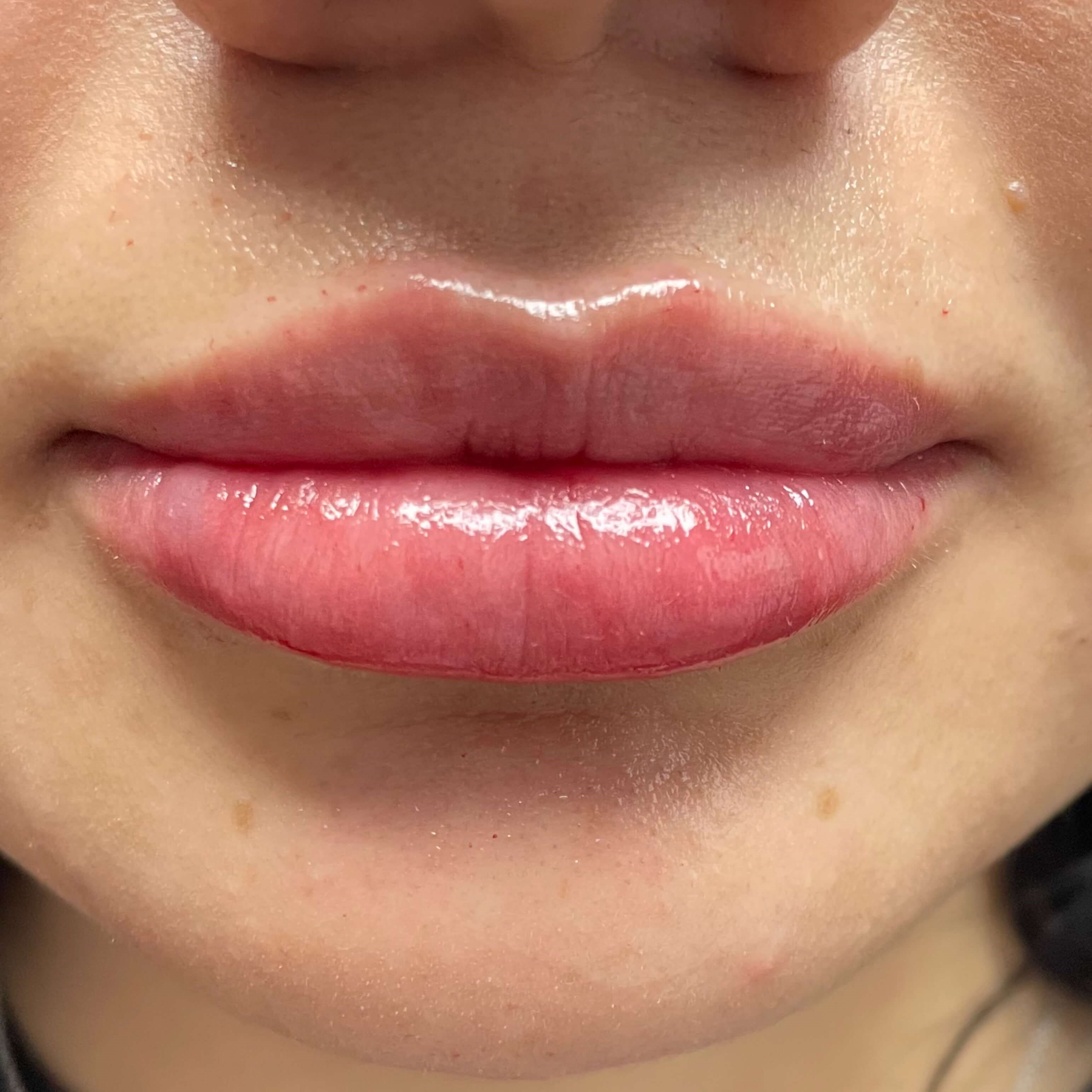 Lip Filler After