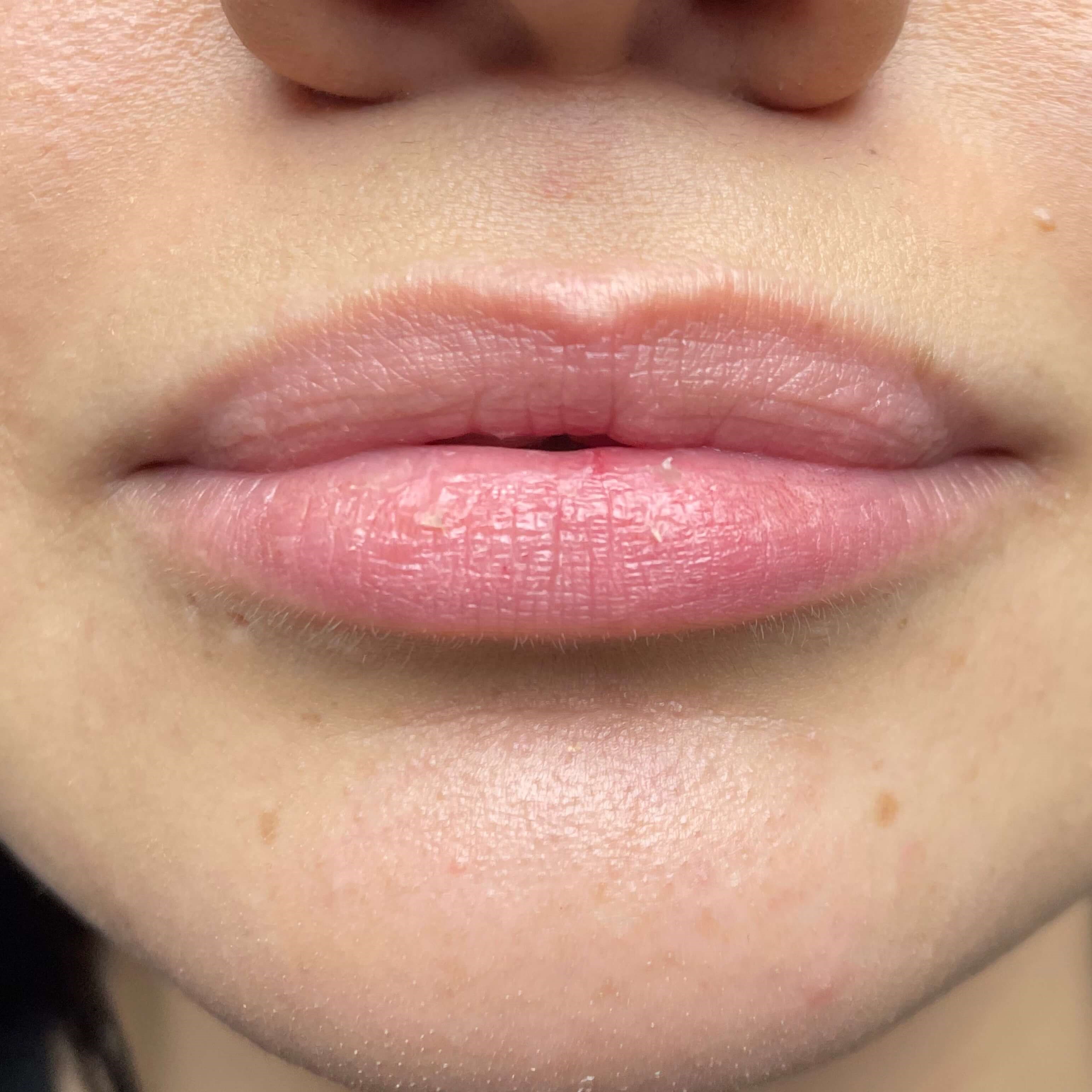 Lip Filler Before