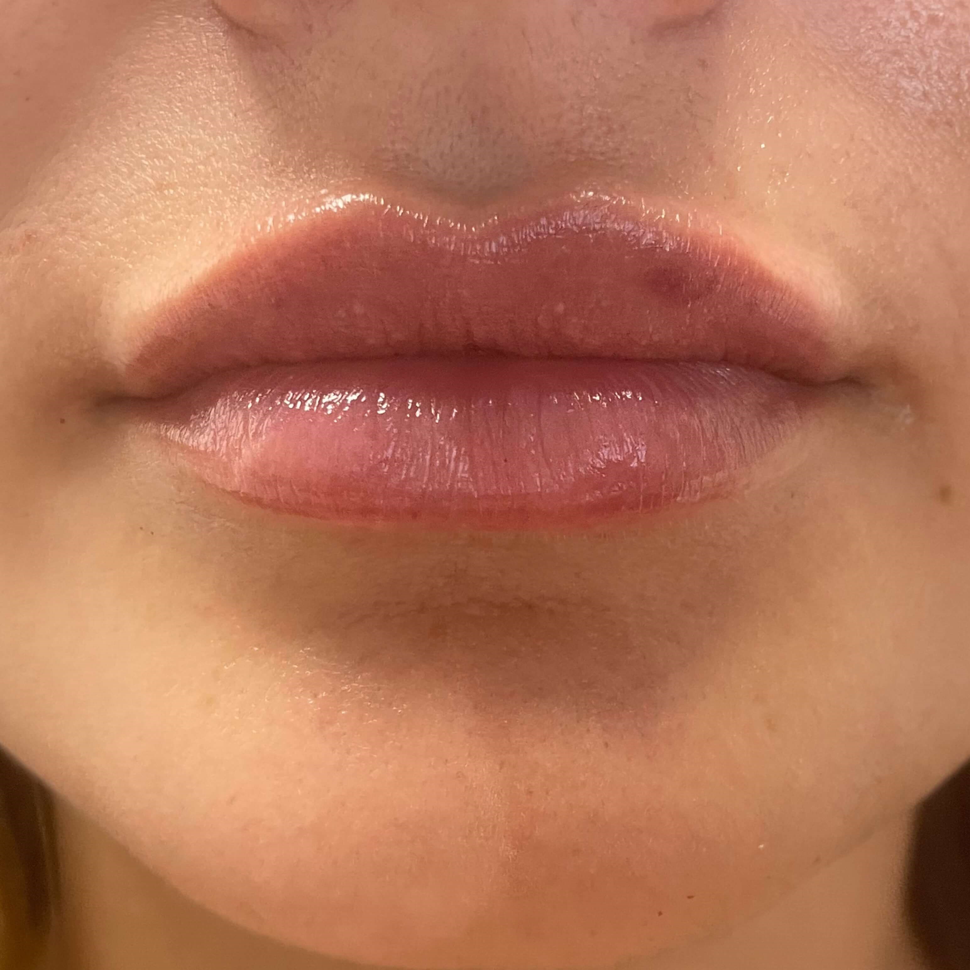 Lip Filler After