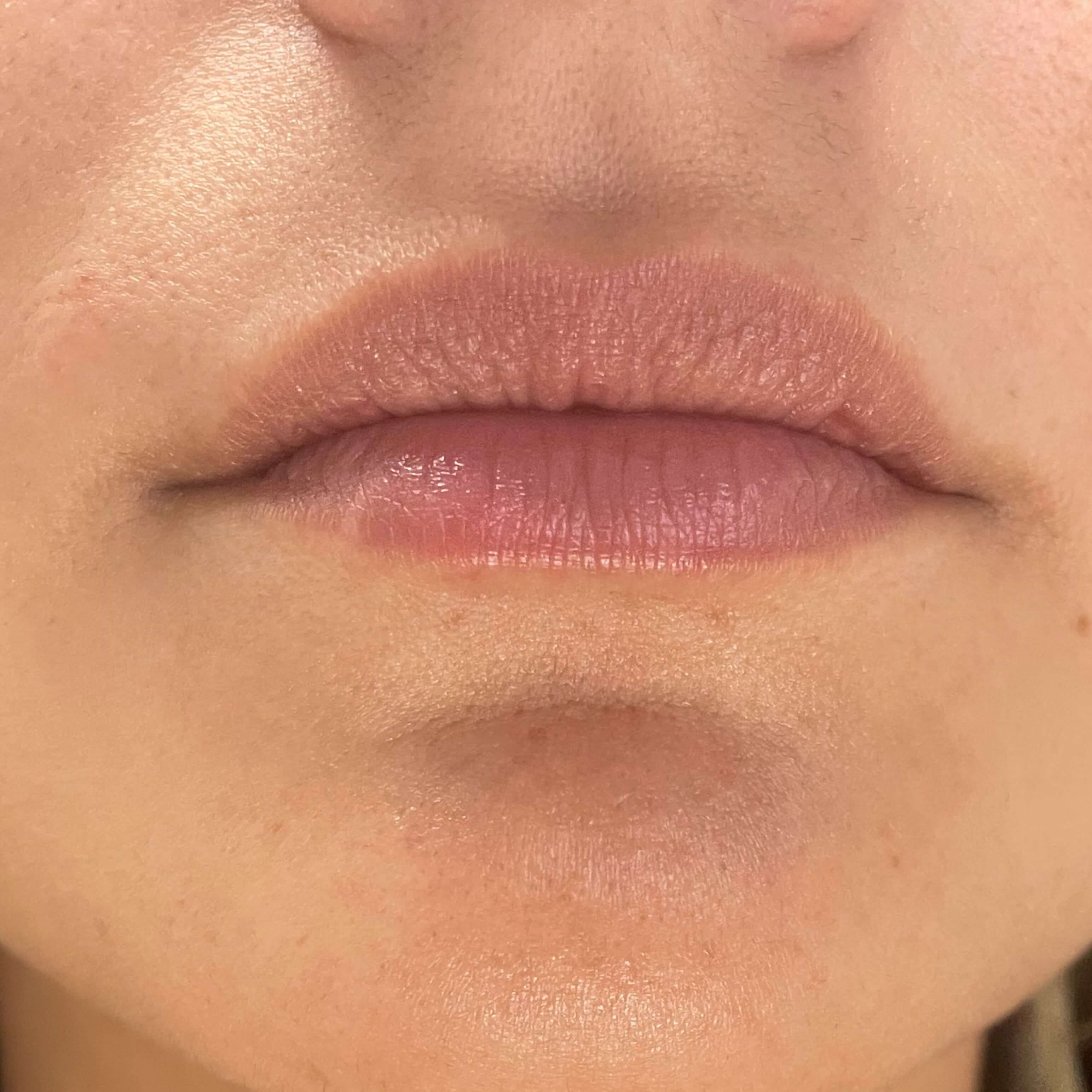 Lip Filler Before