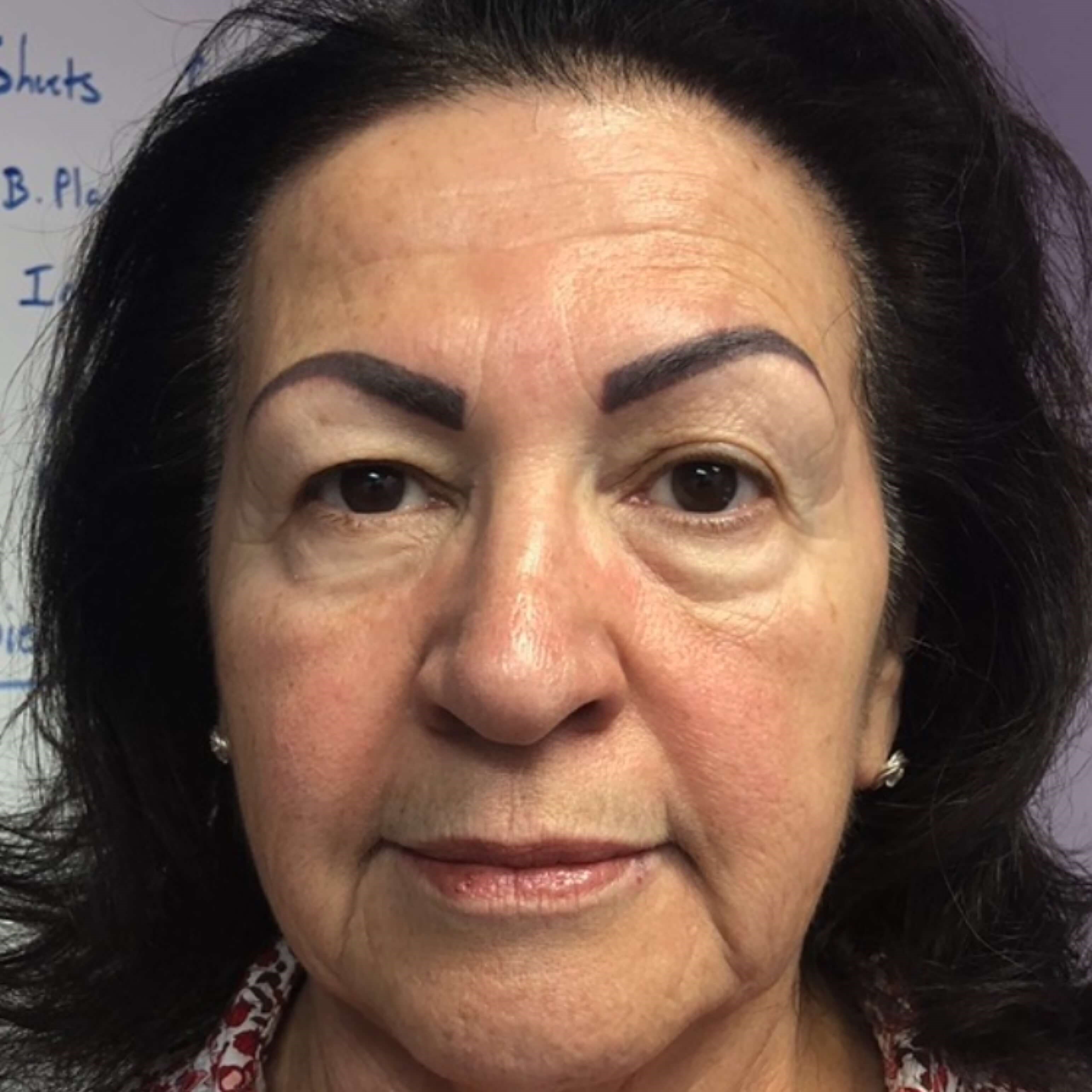 Ultimate Skin Lift Before