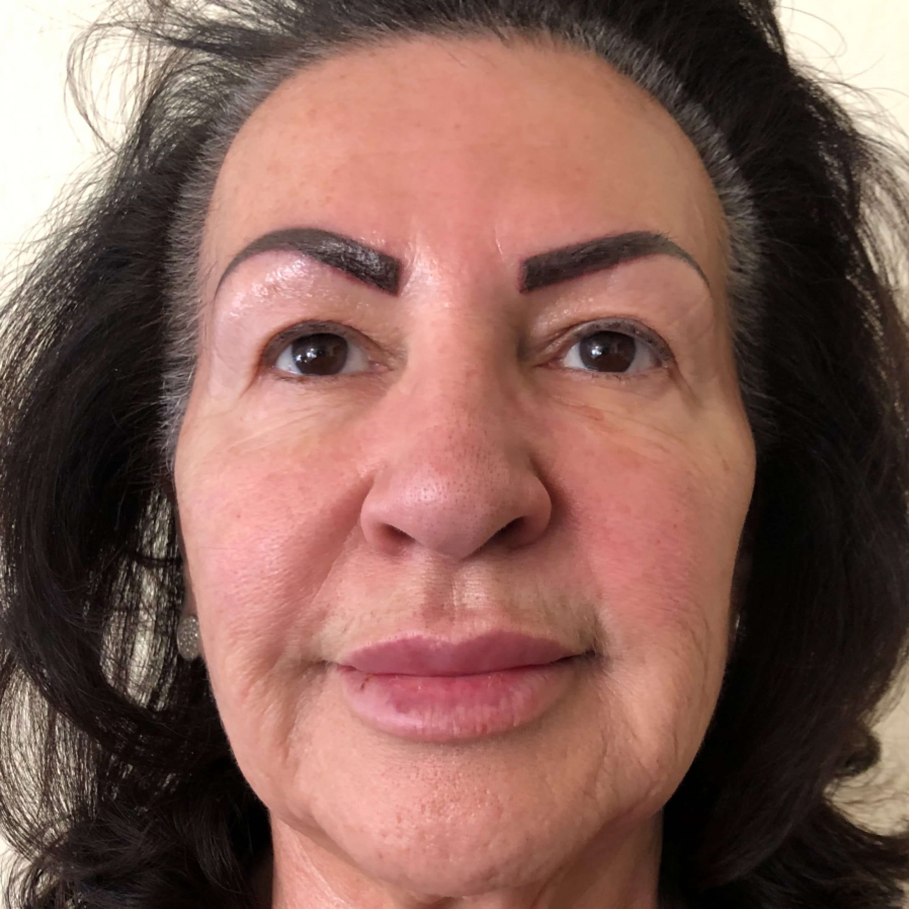 Ultimate Skin Lift After