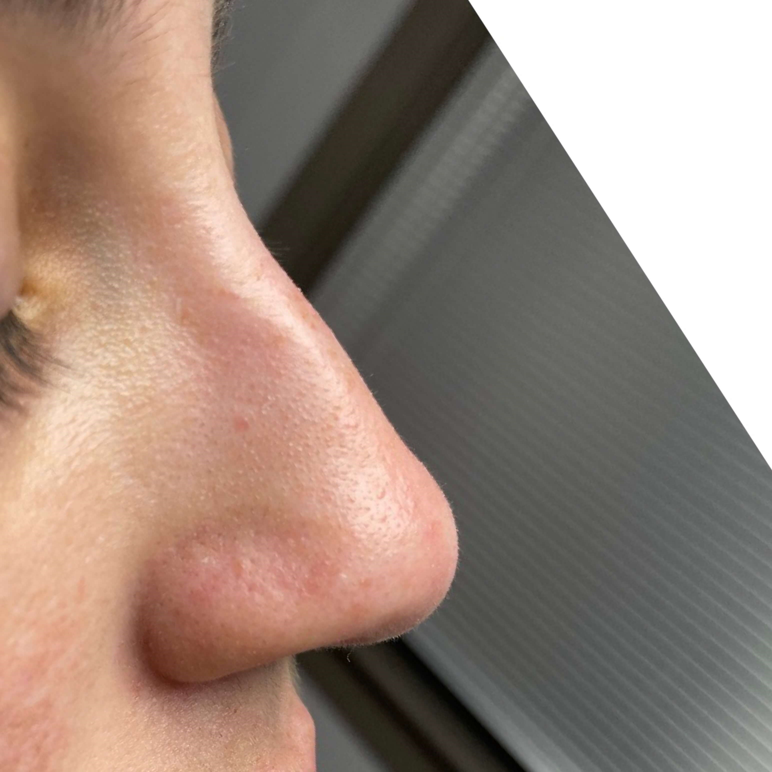 Non Surgical Rhinoplasty Before