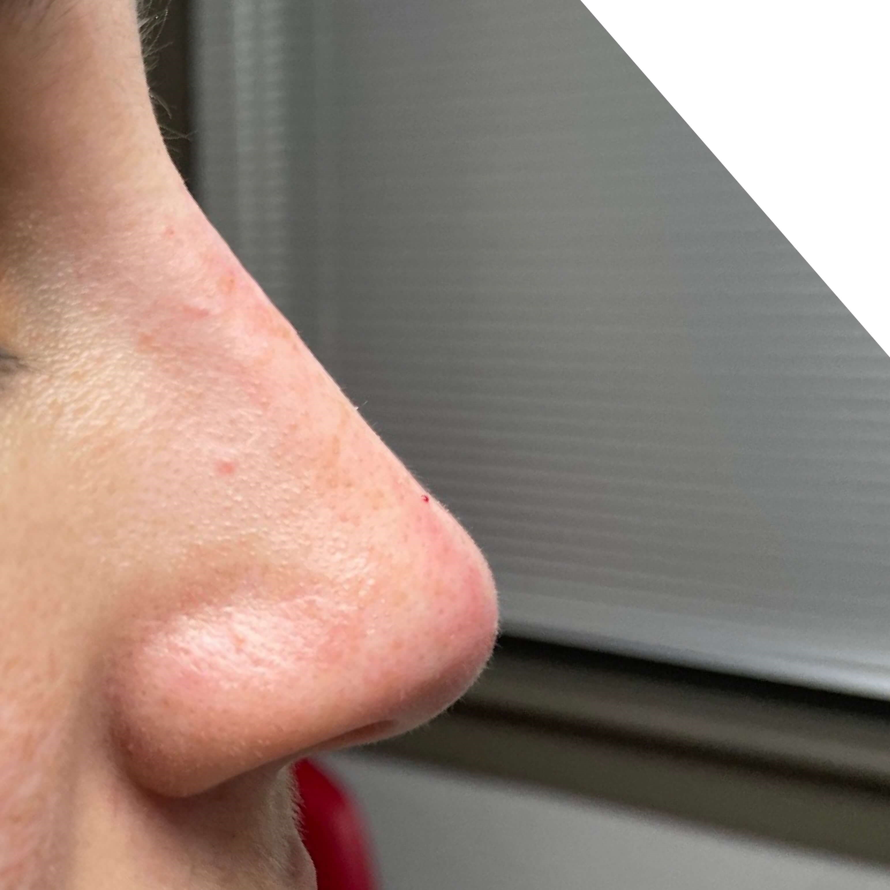 Non Surgical Rhinoplasty After