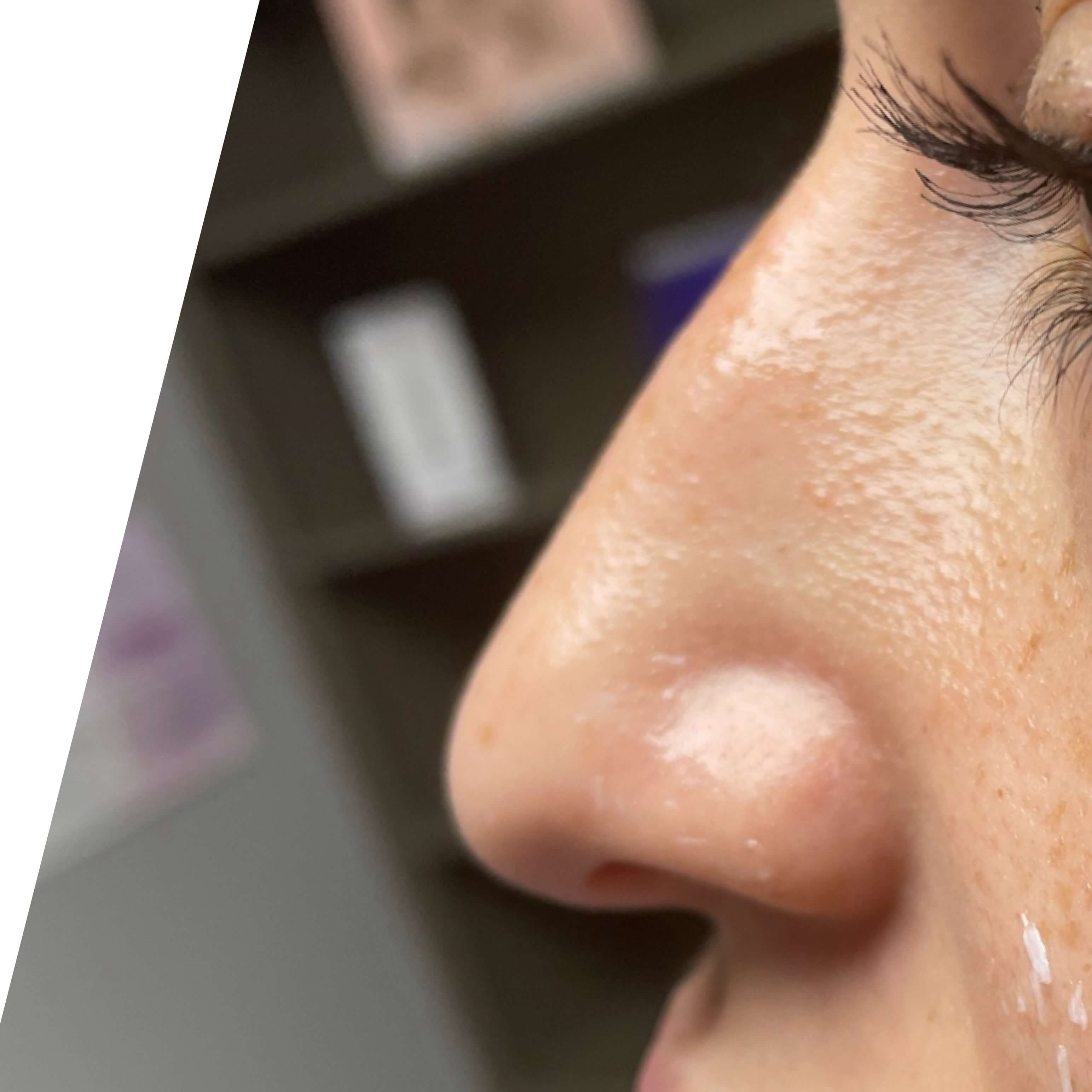 Non Surgical Rhinoplasty Before