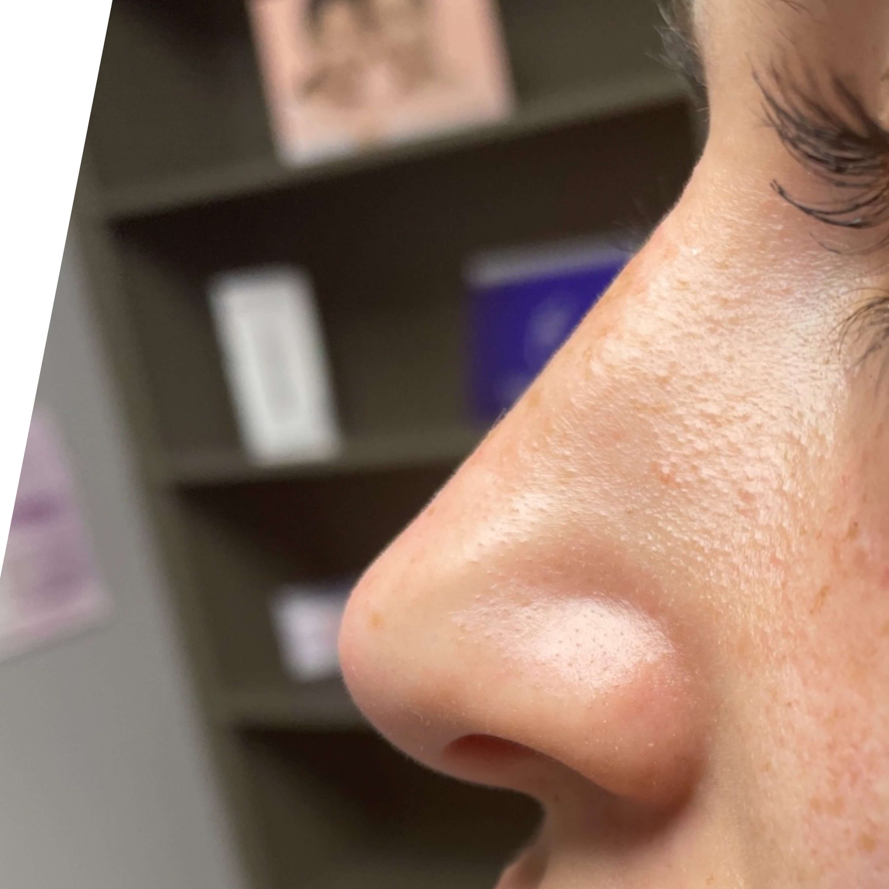 Non Surgical Rhinoplasty After