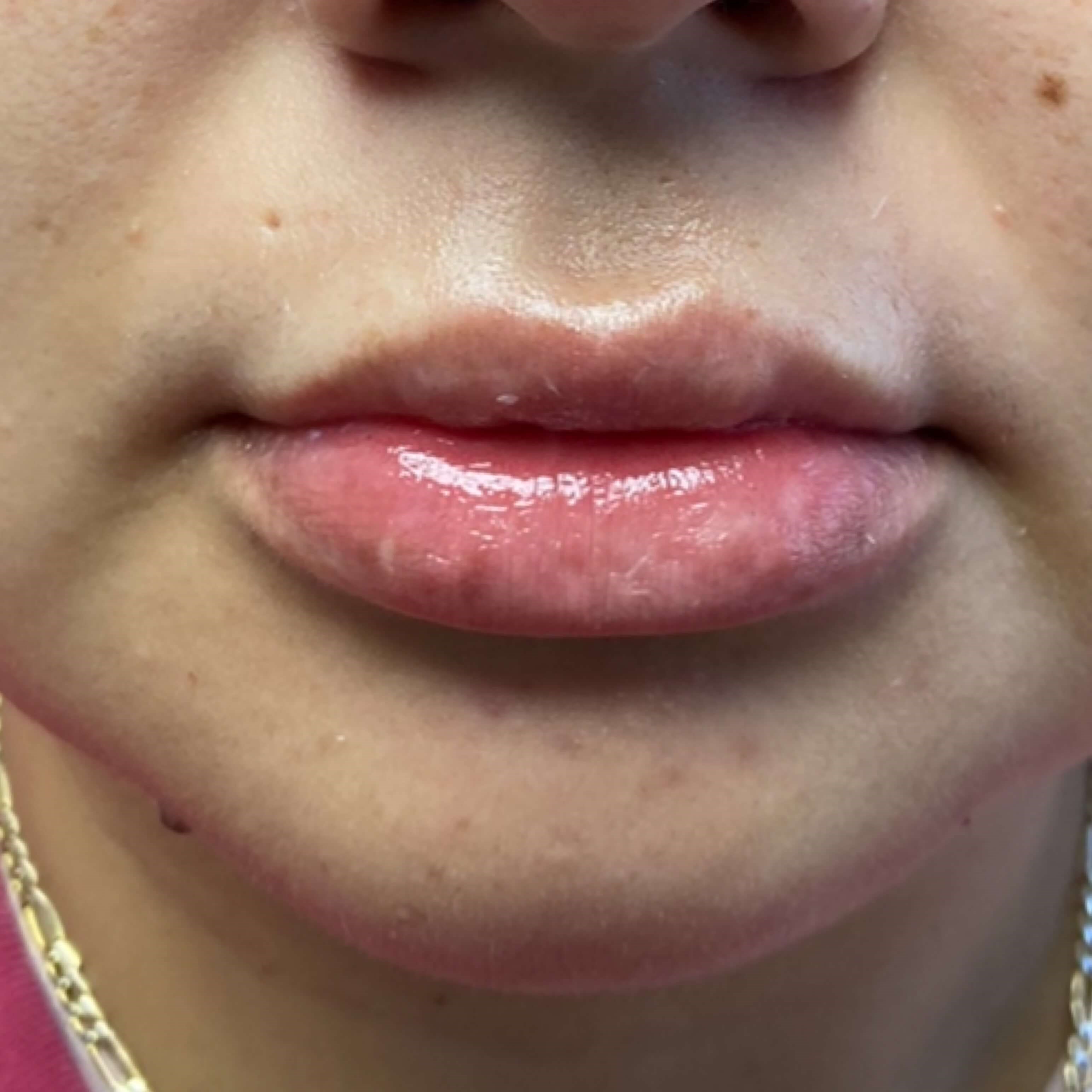 Lip Filler Before