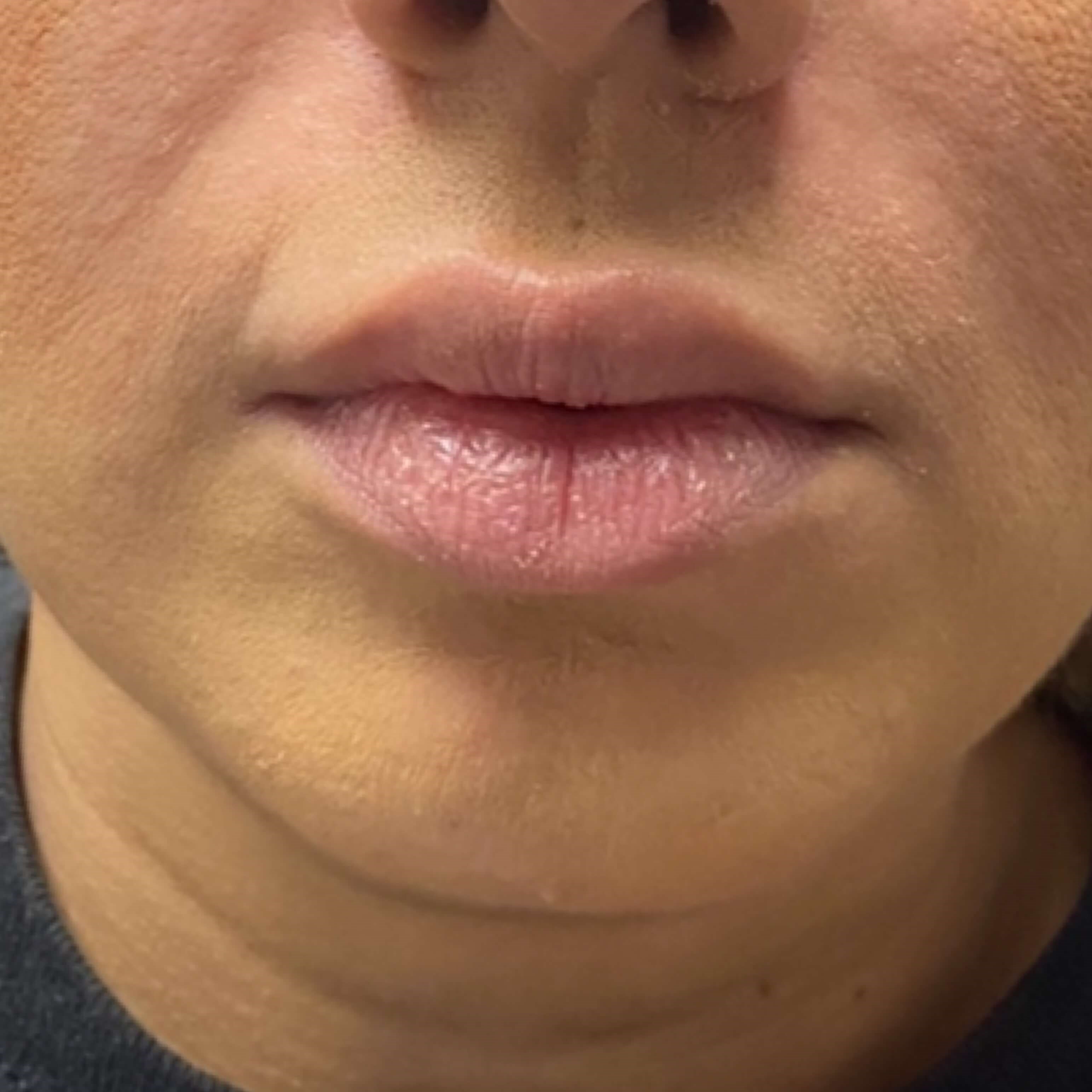 Lip Filler Before