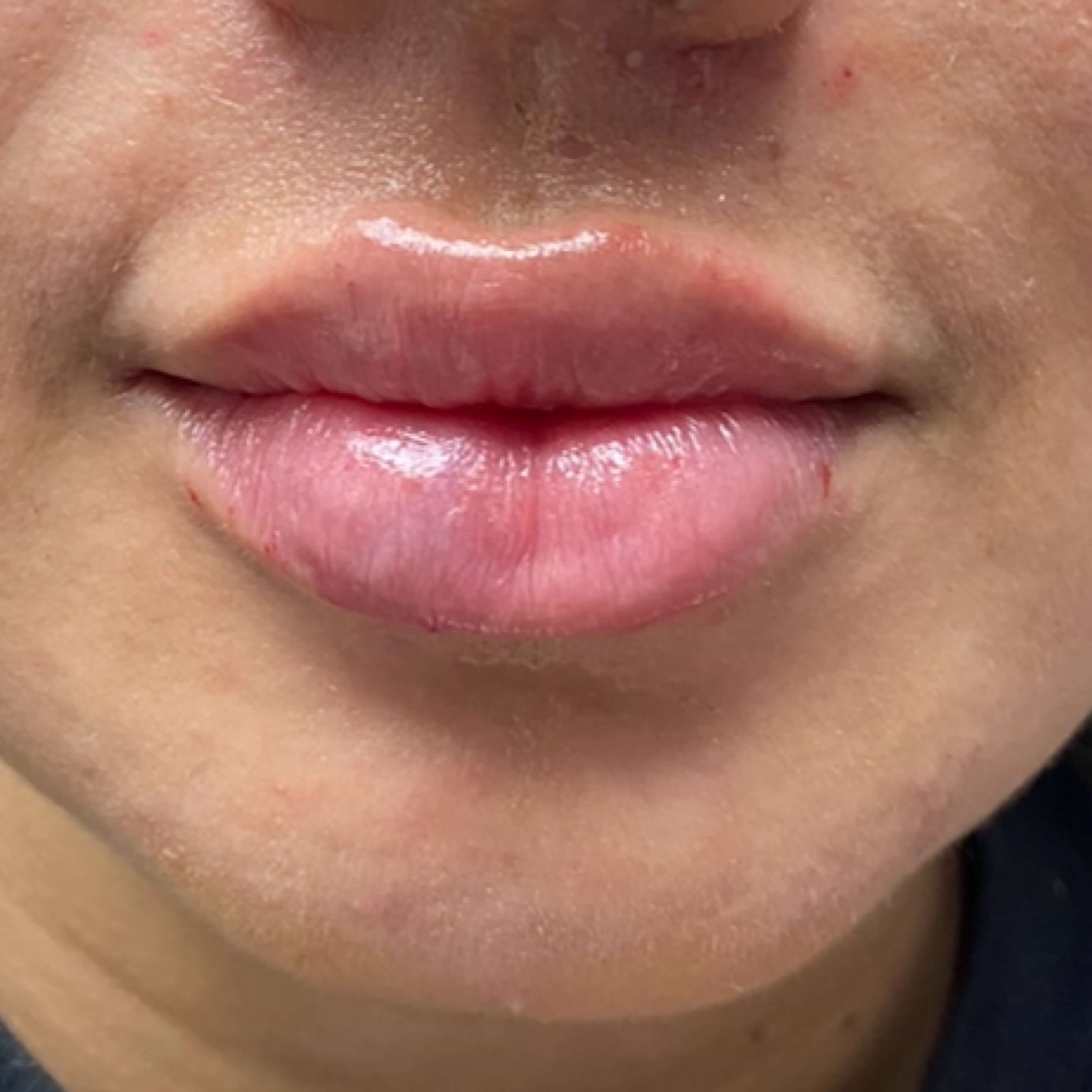 Lip Filler After